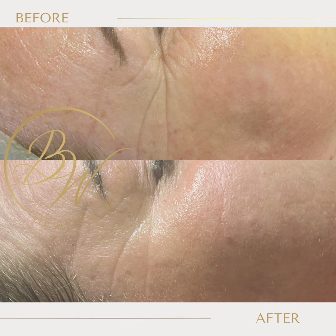 What is the best Treatment for Skin Tightening?